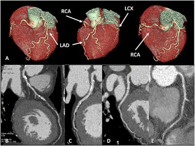 The Potential Role of Cardiac CT in the Evaluation of Patients With Known or Suspected Cardiomyopathy: From Traditional Indications to Novel Clinical Applications